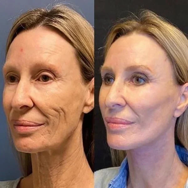 Botox gezichtsserum - 1+1 Gratis