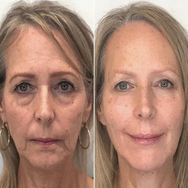 Botox gezichtsserum - 1+1 Gratis